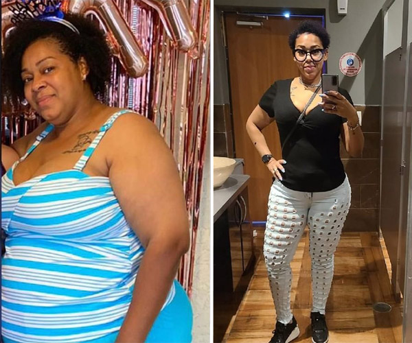 Weight Loss Surgery Before And After Moon Gastric Sleeve