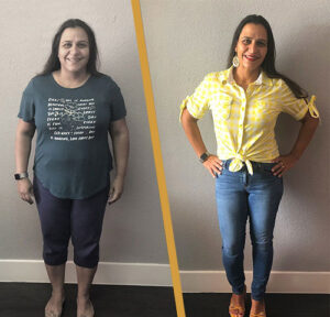 Gastric Sleeve patient 1 Before and After