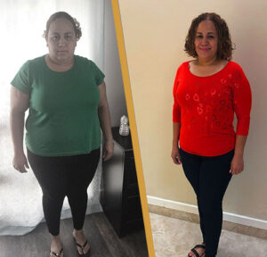 Gastric Sleeve Before patient 2 before and After
