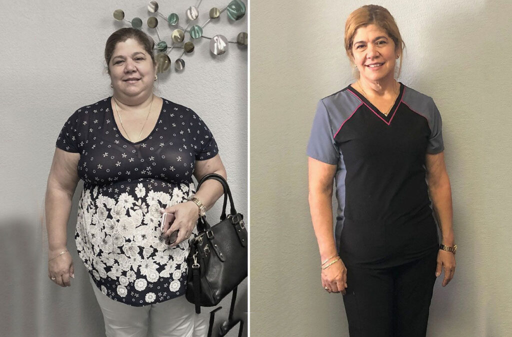 gastric sleeve by dr sosa before and after patient 6