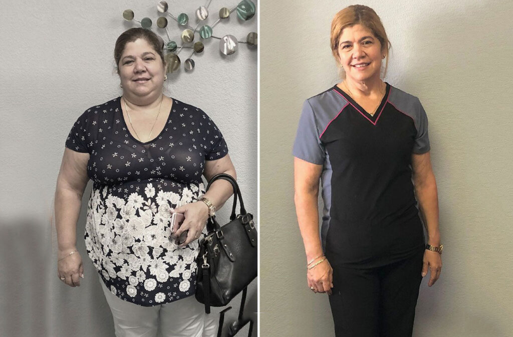 Bariatric surgery patient before and after