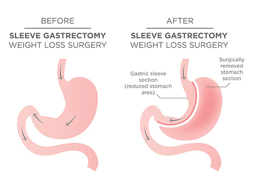 gastric sleeve infographic