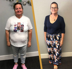 Gastric Sleeve Before patient 3 before and After