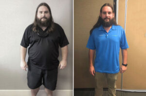 Weight loss surgery patient before and after