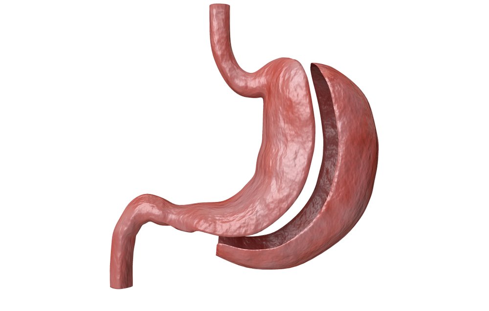 Benefits and Drawbacks of Gastric Sleeve Surgery