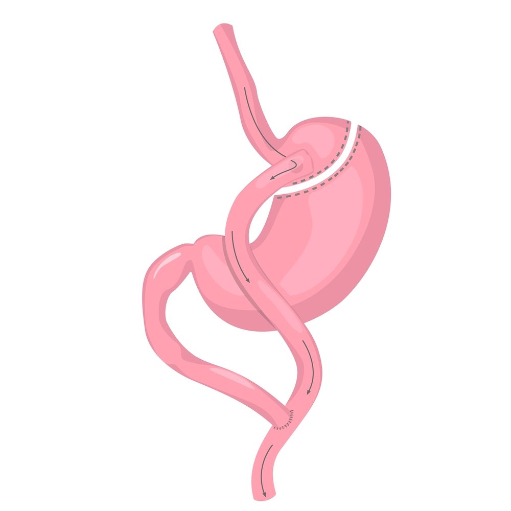 Factors to Consider When Choosing Between Gastric Sleeve and Gastric Bypass