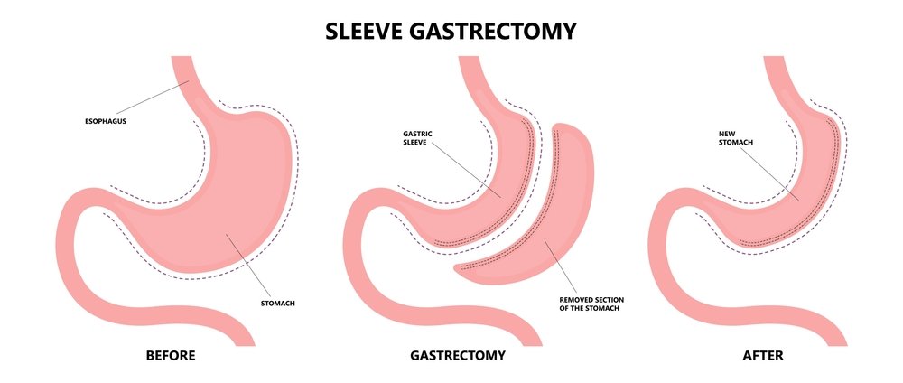 Hungry Every 2 Hours After Gastric Sleeve Surgery Solutions
