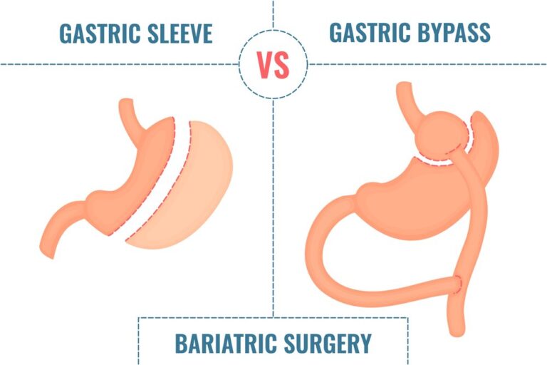 Gastric Sleeve vs. Gastric Bypass: Surgical Options Compared