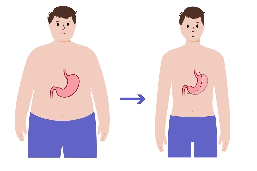 Transformations Gastric Sleeve Before And After 3 Months