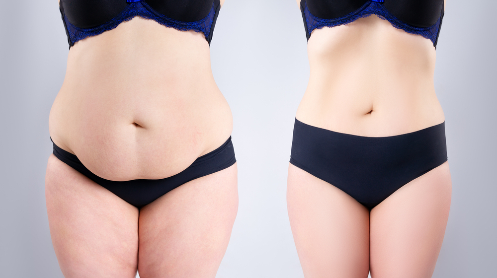 Understanding Gastric Sleeve Surgery and its Effects on the Skin