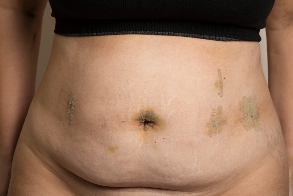 Scarring after Gastric Sleeve Surgery - Minimize Scars after Sleeve