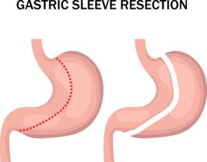 Can You Chew Gum After Gastric Sleeve? What to Consider