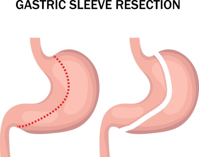 Can you chew gum after gastric sleeve