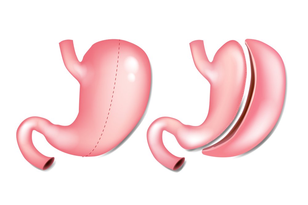 When Can I Eat Tortillas After Gastric Sleeve Find Out 