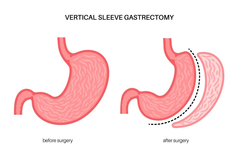 When Can I Eat Tortillas After Gastric Sleeve Find Out 