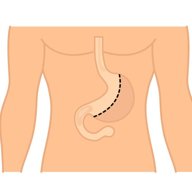 Reasons for Considering Lap Band Revision to Gastric Sleeve