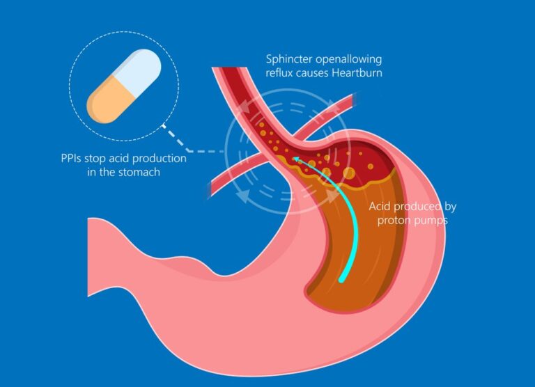 Omeprazole After Gastric Sleeve Managing Acid Reflux