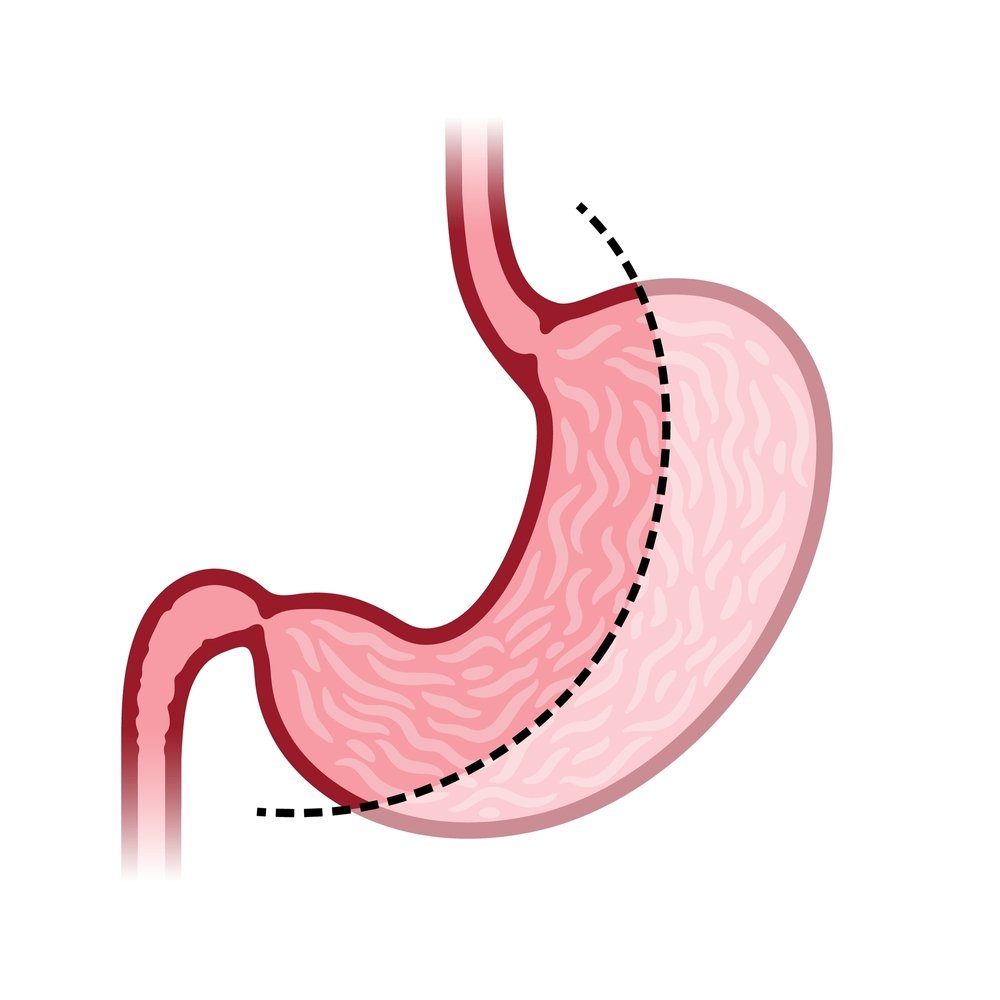 Where Are the Incisions Placed in Gastric Sleeve Surgery
